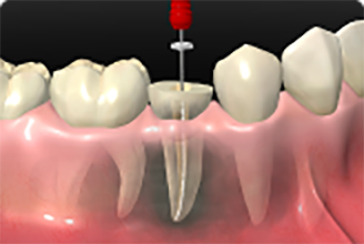 根管治療