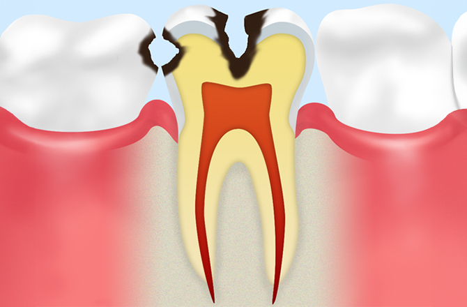 C2：本格的に進行し始めた虫歯