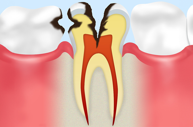 C3：神経まで進行した虫歯